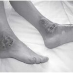 pioderma gangrenoso