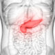 ¿Cómo se clasifica la pancreatitis aguda?