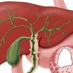 Colangitis esclerosante primaria