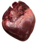 ¿Qué es la Miocardiopatía dilatada?