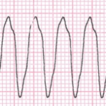 ¿Qué es la taquicardia ventricular?