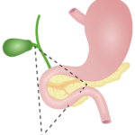 ¿Qué es un gastrinoma?
