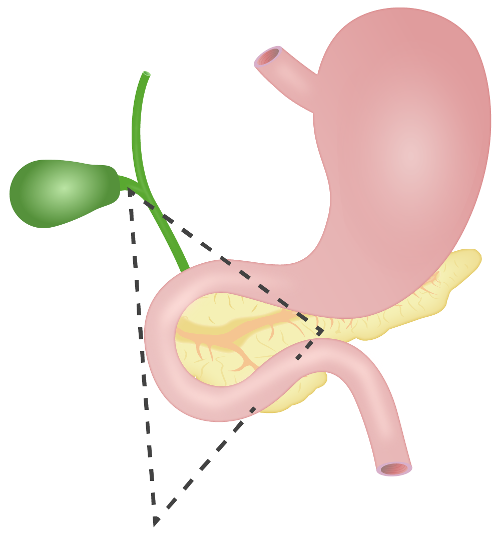 ¿Qué es un gastrinoma? GastroenterologíaHomo medicus