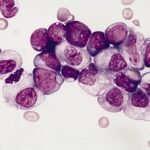 ¿Cuáles son las causas de la leucemia mieloide aguda?