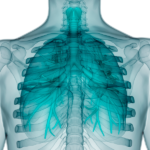 ¿Qué es la sarcoidosis?