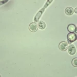 Infecciones mucocutáneas frecuentes causadas por Candida en pacientes con diabetes mellitus.