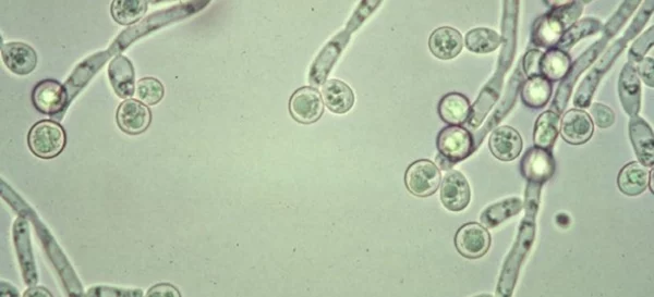 Infecciones mucocutáneas frecuentes causadas por Candida en pacientes con diabetes mellitus.