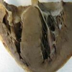 ¿Qué es la Miocardiopatía restrictiva?
