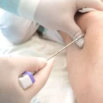 ¿Cómo se realiza un aspirado de médula ósea?
