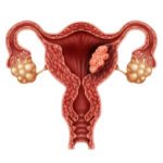 ¿Cuáles son los factores de riesgo para el cáncer de endometrio?