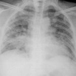 ¿Qué es la neumonitis por hipersensibilidad?