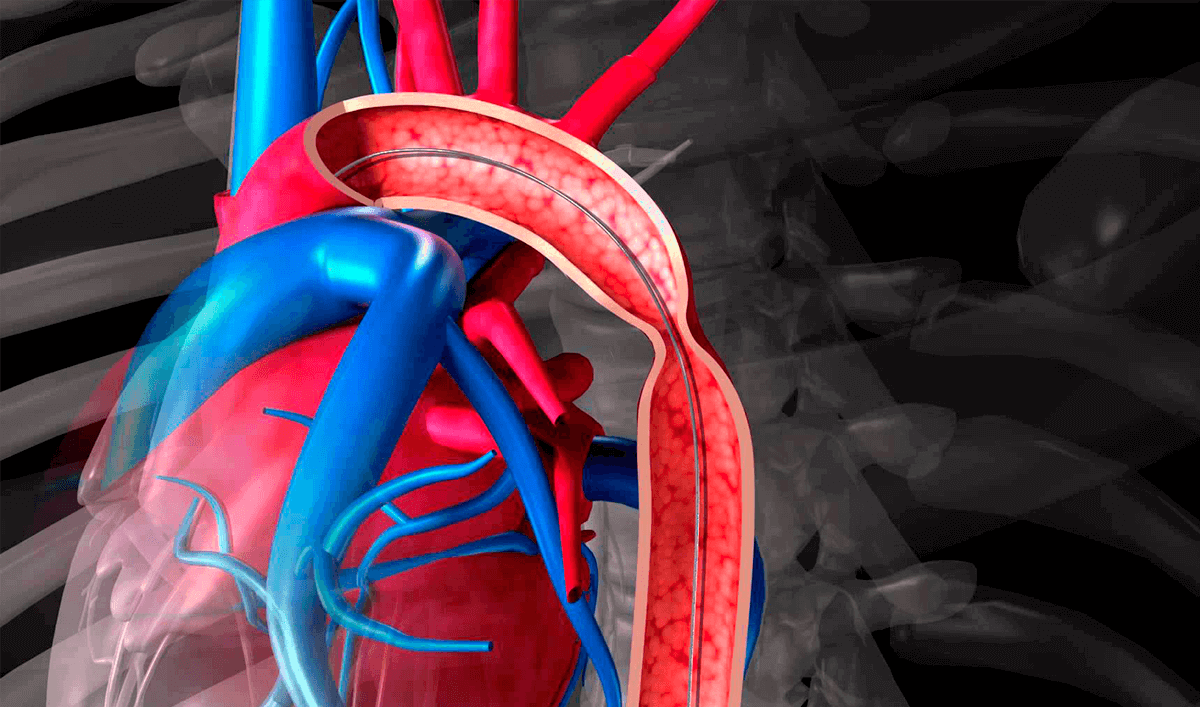 Aorta Obstruida Homo Medicus aorta-obstruida-homo-medicus