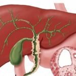 ¿Cuáles son las manifestaciones extrahepáticas de colangitis biliar primaria?