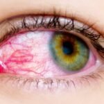 ¿Cuáles son las causas de dolor o enrojecimiento ocular?