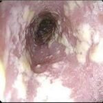 Candidiasis esofágica