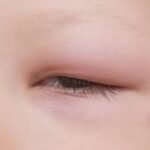 Celulitis preseptal causada por Haemophilus influenza en niños.