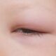 Celulitis preseptal causada por Haemophilus influenza en niños.