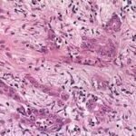 20 cosas que debes saber sobre el cáncer de páncreas.