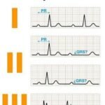 Defectos de la conducción cardiaca Auriculo – ventricular