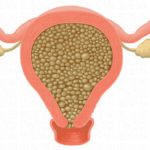 Enfermedad trofoblástica gestacional