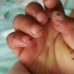 ¿Cuáles son las manifestaciones cutáneas de endocarditis infecciosa?