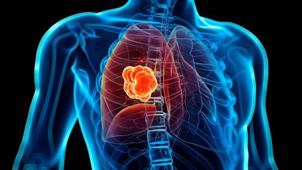 ¿Qué es el cáncer de pulmón?