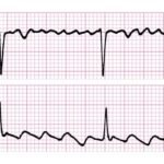 ¿Cómo se trata la fibrilación auricular?