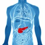 ¿Cuáles son las causas de pancreatitis aguda?