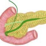 ¿Qué son las neoplasias mucinosas papilares intraductales del páncreas?