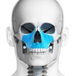 Huesos de macizo facial: maxilar