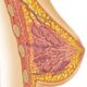 ¿Qué es la ectasia ductal?