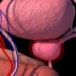 ¿Que es la prostatitis?