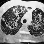 ¿Qué son las bronquiectasias?
