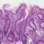 ¿Qué es metaplasia?