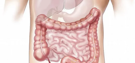 ¿Qué es el síndrome de colon irritable?