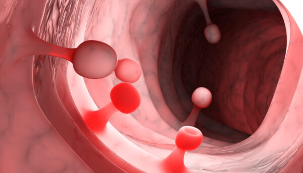 Poliposis adenomatosa familiar