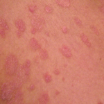 ¿Qué es la pitiriasis rosada?