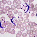 ¿Qué causa la tripanosomiasis africana?