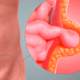 ¿Cuáles son los factores predisponentes de las hernias inguinales?