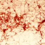 ¿Qué es el Micetoma eumicótico?