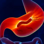 ¿Cuáles son las causas de cáncer gástrico?