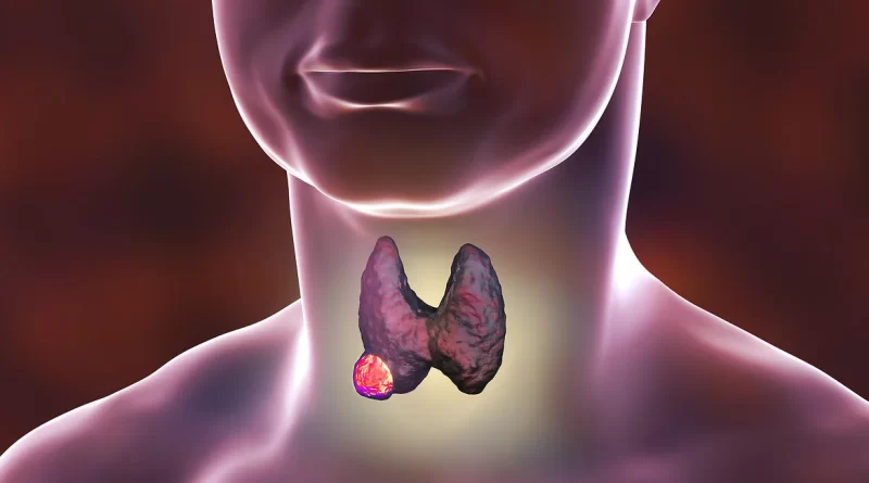 ¿Qué tipos de cáncer se desarrollan en la glándula tiroides?