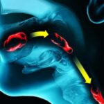 ¿Cuáles son las causas de disfagia bucofaríngea?