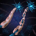 ¿Cuáles son los factores de riesgo para esclerosis múltiple?