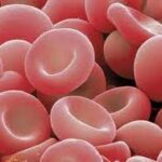¿Cuáles son las causas de anemia hipoproliferativa?