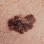 Factores de riesgo para melanoma