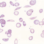 ¿Cómo se clasifican las hemoglobinopatías?