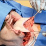 Transferencia de tejido libre en lesiones de cabeza y cuello