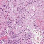 Tipos histológicos de neoplasia trofoblástica gestacional