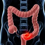 ¿Cuáles son los factores de riesgo para cáncer colorrectal